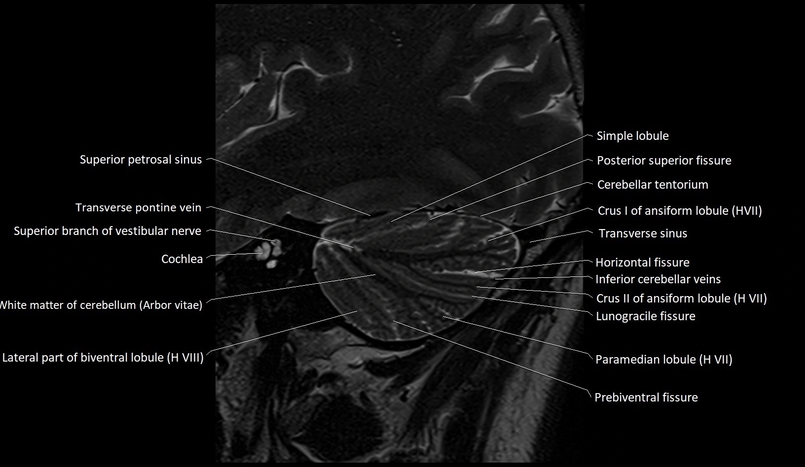 MRI Cerebellar anatomy sagittal High-resolution labelled image 11.webp